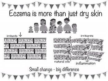 Image for Eczema Mindlines research project